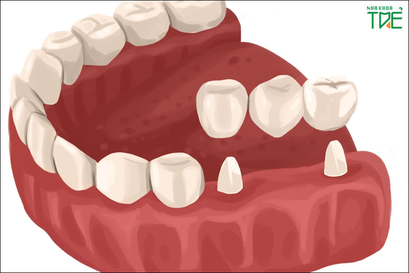 Cầu răng sứ tương đối bền nếu được chăm sóc đúng cách