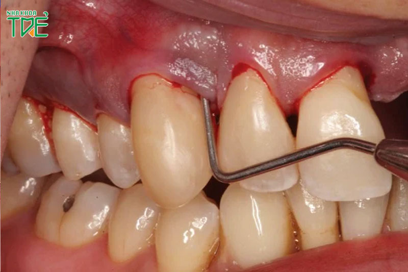 CẢNH GIÁC: Biến chứng lấy cao răng xong bị chảy máu liên tục