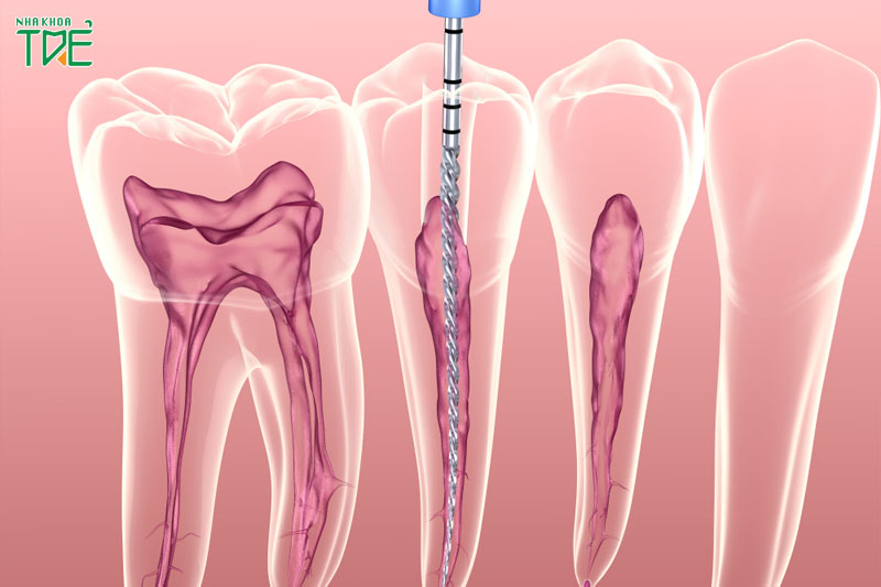Chi phí chữa tủy răng phụ thuộc vào vị trí răng viêm tủy