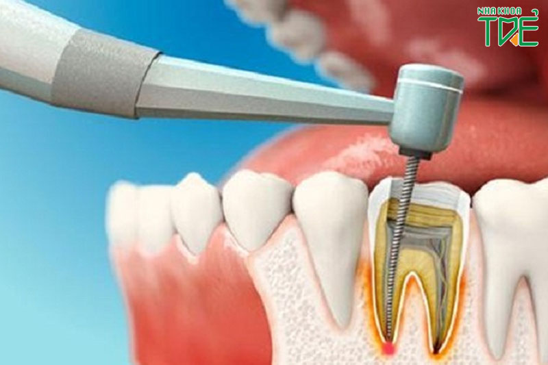 Ứng dụng công nghệ điều trị tủy răng hiện đại mang lại kết quả tối ưu
