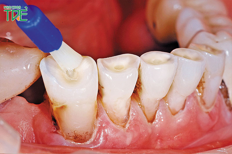 Trám bít răng sau điều trị ngà răng để bảo tồn răng tối ưu