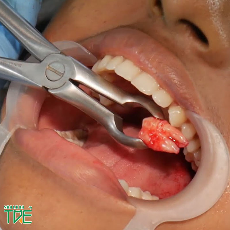 Nhổ răng khôn hàm trên có nguy hiểm không? Giá bao nhiêu tiền?