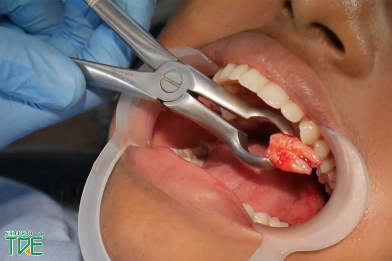 Nhổ răng khôn hàm trên có nguy hiểm không? Giá bao nhiêu tiền?