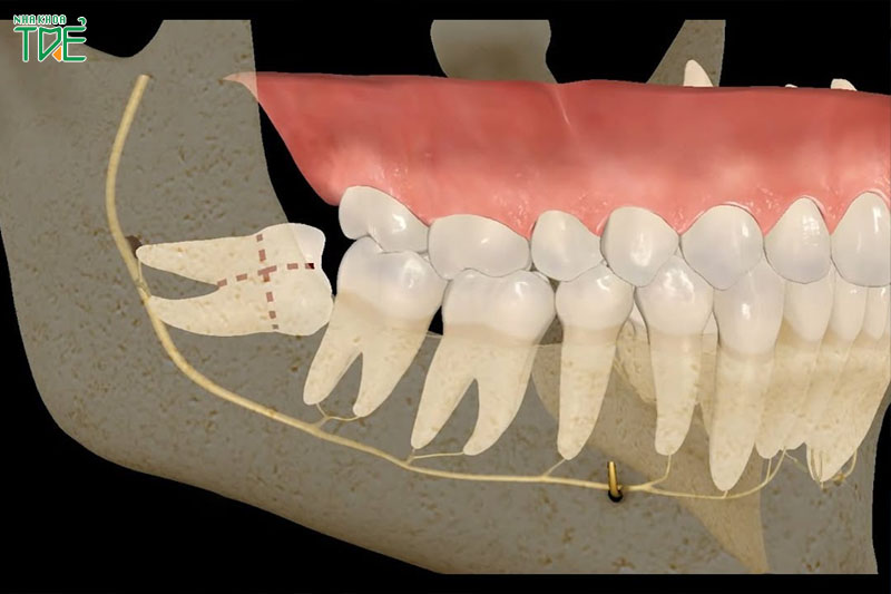 Nhổ răng khôn sai kỹ thuật có thể tác động xấu đến dây thần kinh quanh răng