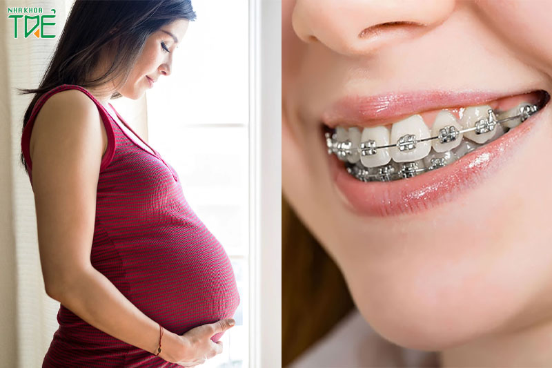 Niềng răng bao lâu thì nên có bầu? Những lưu ý quan trọng cho bầu
