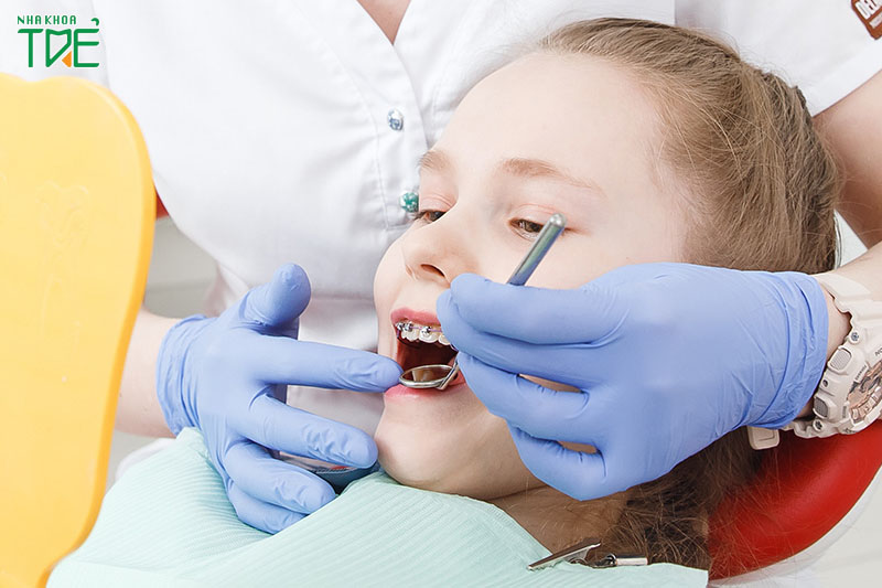 Niềng răng cho trẻ em để khắc phục các khiếm khuyết của hàm răng
