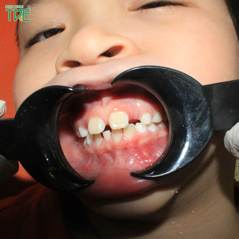Niềng răng cho trẻ đang thay răng sữa có được không? Có hiệu quả không?