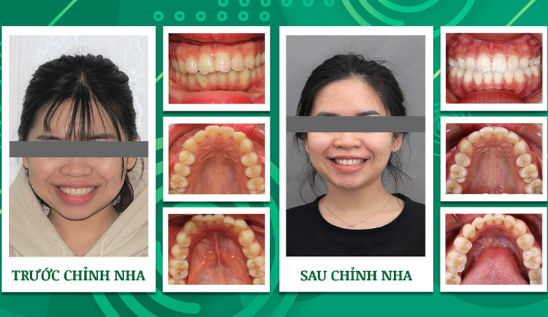 Hình ảnh trước và sau niềng răng của khách hàng nha khoa Trẻ