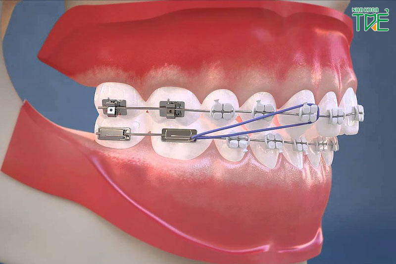 Niềng răng để khắc phục triệt để các khiếm khuyết của hàm răng
