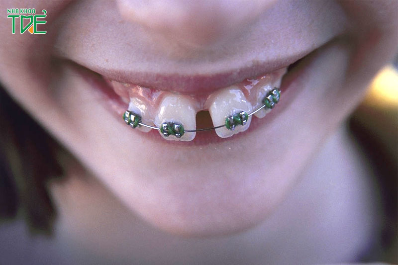 Niềng răng hô cho trẻ em có được không? Độ tuổi nào thích hợp nhất