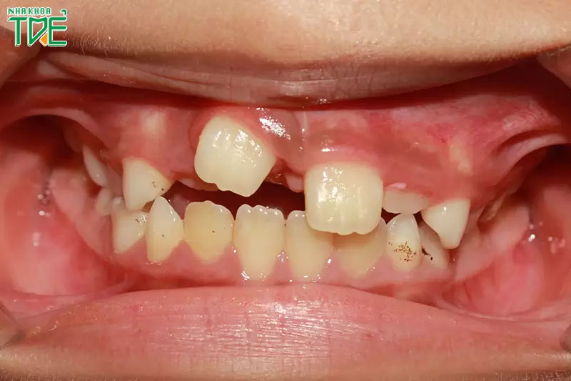 Tình trạng răng lệch lạc ở trẻ cần xử lý sớm ngay ở giai đoạn thay răng sữa