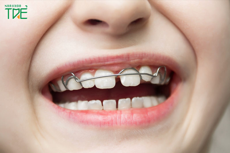 Niềng răng tháo lắp kim loại giúp điều chỉnh các lệch lạc nhẹ