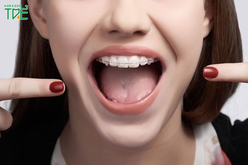 Niềng răng diễn ra theo từng giai đoạn khác nhau