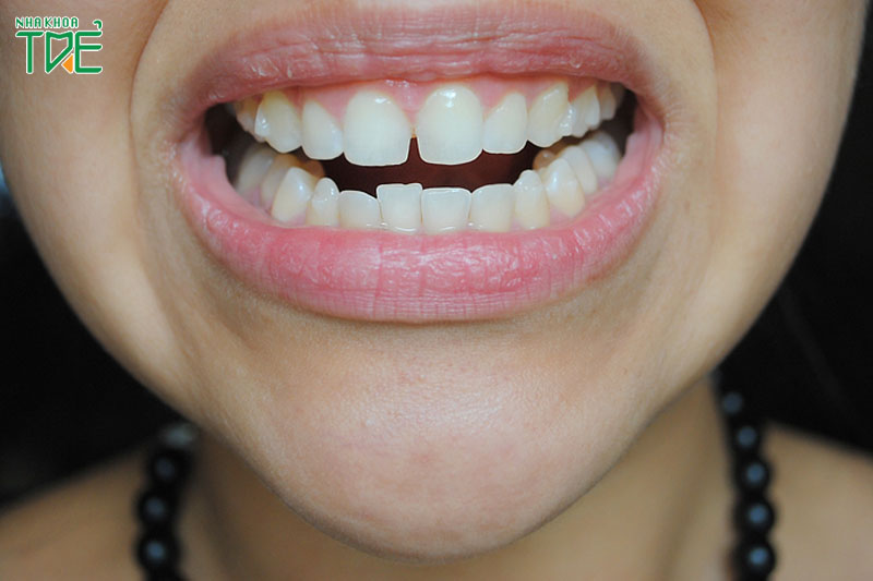 Niềng răng xong bị chạy lại có thể xảy ra do nhiều nguyên nhân khác nhau