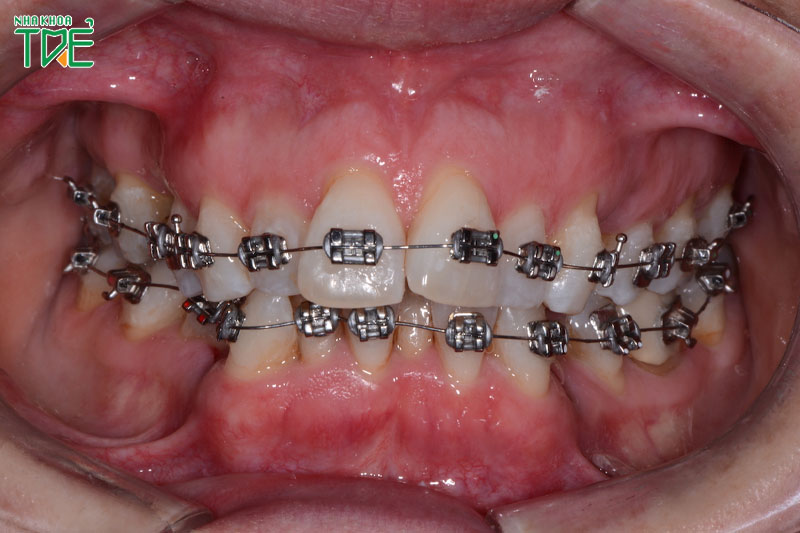 Niềng răng khắc phục các tình trạng răng lệch lạc