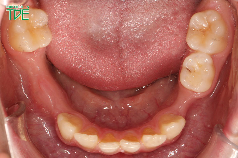 Phục hình răng cố định để khắc phục tình trạng mất răng
