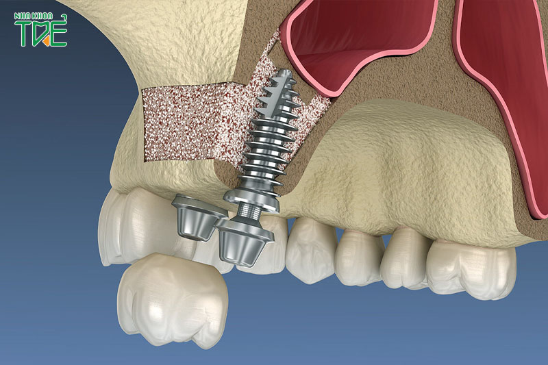 Cấy ghép Implant trực tiếp vào trong xương hàm