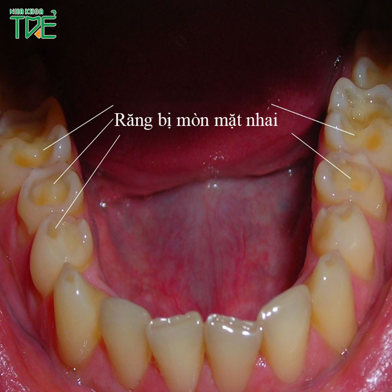 Răng bị mòn mặt nhai phải khắc phục như thế nào?