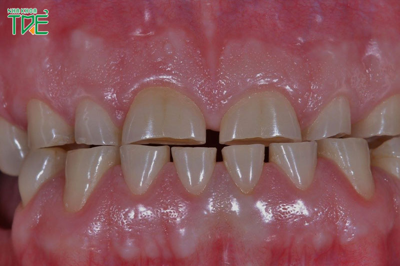 Răng bị mòn nhiều sẽ làm suy giảm chức năng ăn nhai, gây hai cho khớp hàm