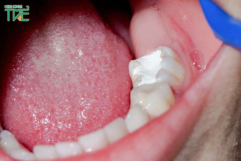 Trám răng cho răng bị mòn là phương pháp điều trị tạm thời