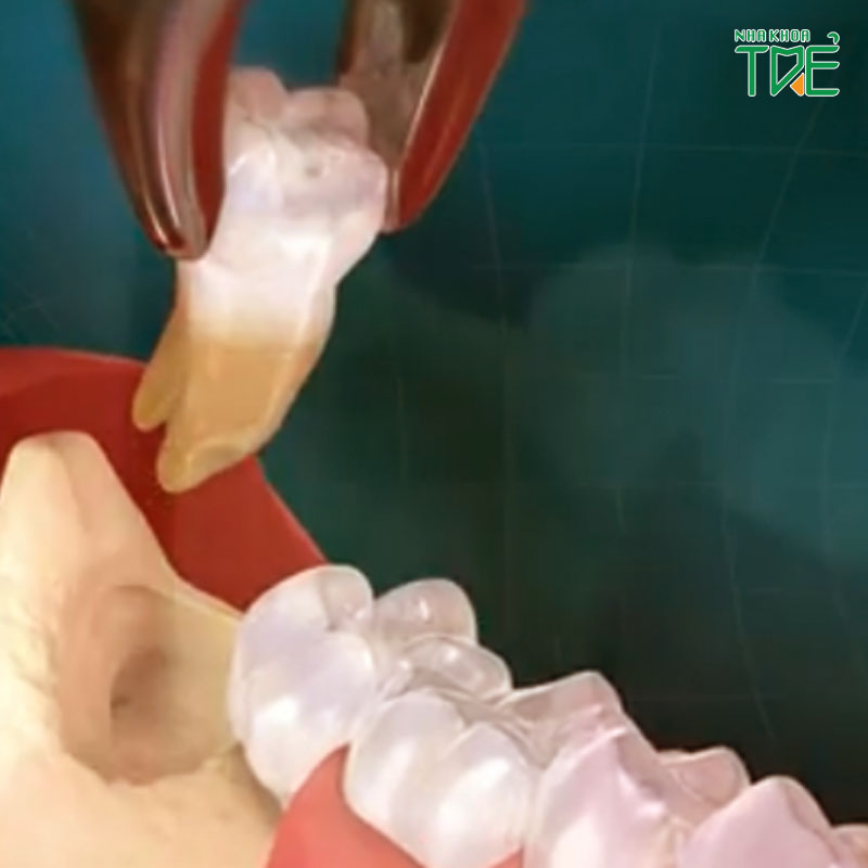 Răng khôn không đau có nên nhổ bỏ không?