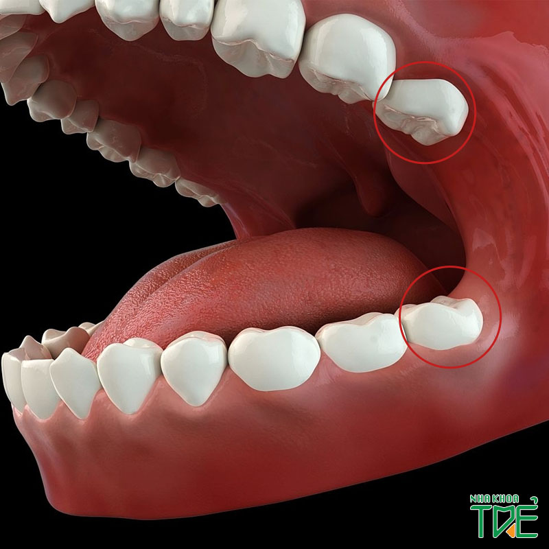 Răng khôn không mọc có phải hiện tượng bất thường?
