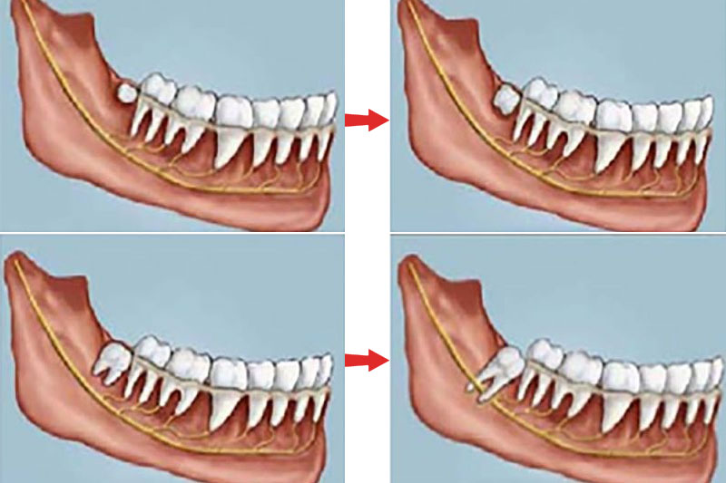 Răng khôn mọc trong bao lâu? Các triệu chứng bất thường cần lưu ý