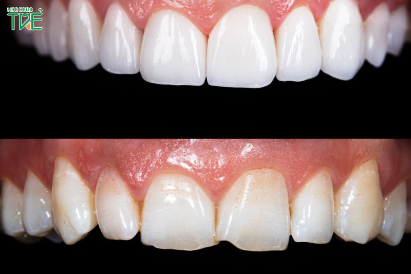 Bọc răng sứ nhằm cải thiện khiếm khuyết về mặt hình thể của răng
