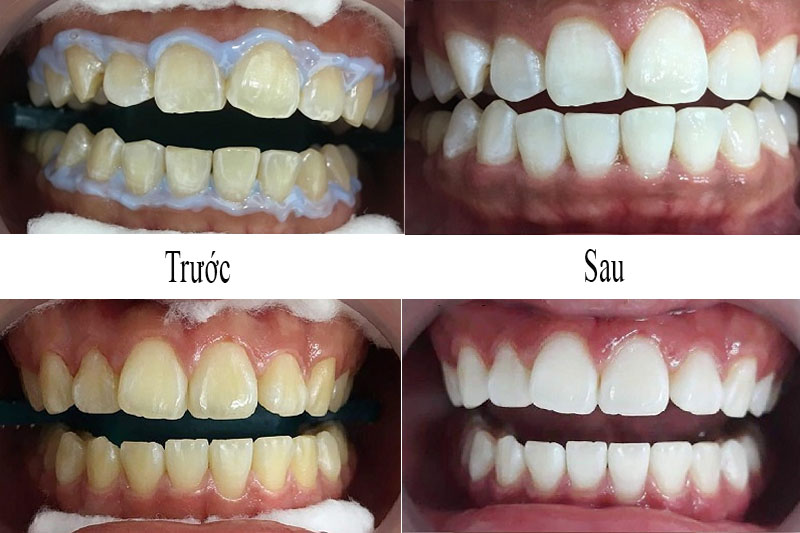Tẩy trắng răng hiệu quả tại Nha khoa Trẻ
