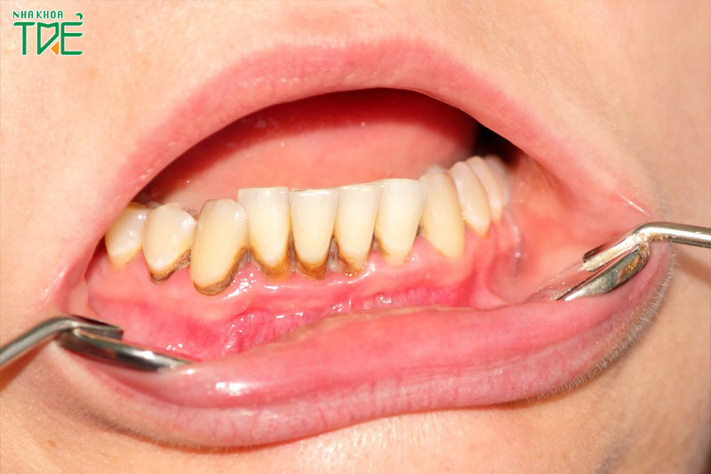 Cần lấy cao răng định kỳ để loại bỏ mảng bám ở chân răng
