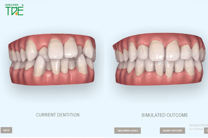 Tăng khả năng dự đoán răng dịch chuyển đúng tới 75% so với vật liệu khác