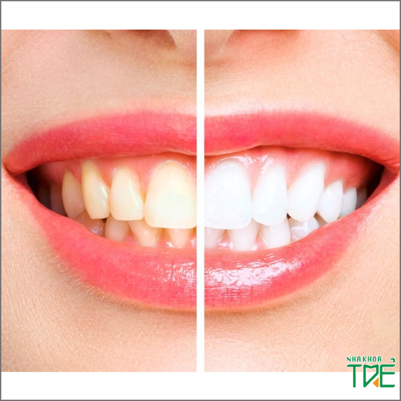 Tẩy trắng răng có bị vàng lại không? Cách chăm sóc giúp răng luôn trắng sáng