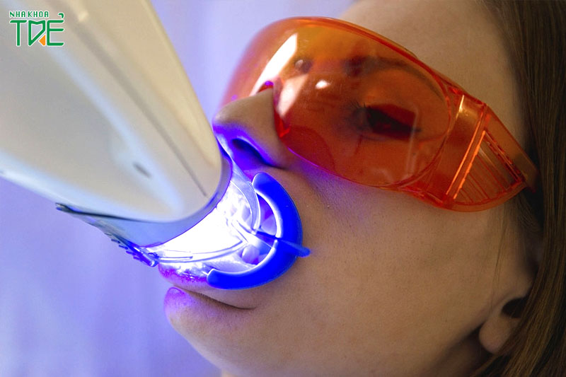 Tẩy trắng răng Laser duy trì độ trắng sáng lâu dài