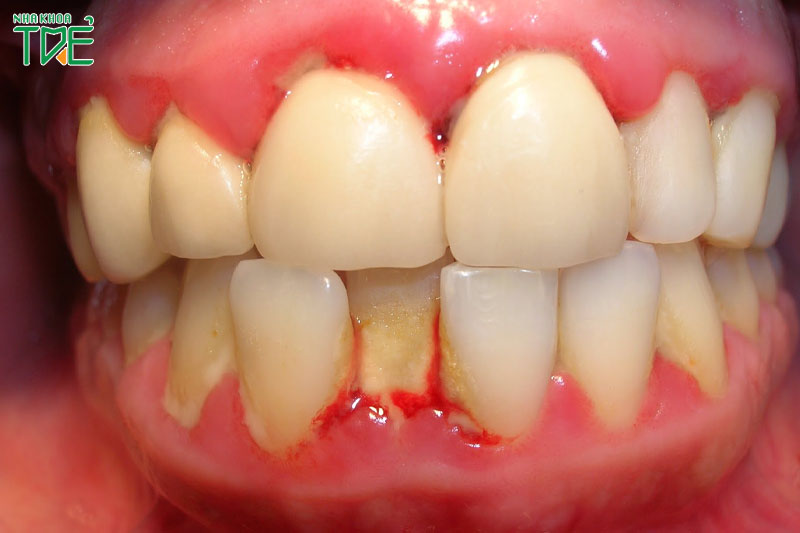 Các bệnh lý răng miệng cần điều trị triệt để trước khi tẩy trắng răng
