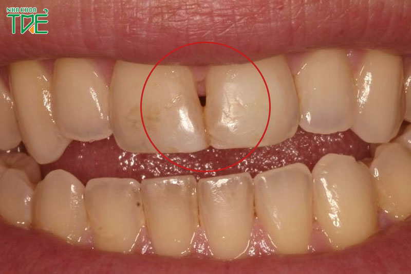 Trám kẽ răng thưa để khắc phục khiếm khuyết của răng