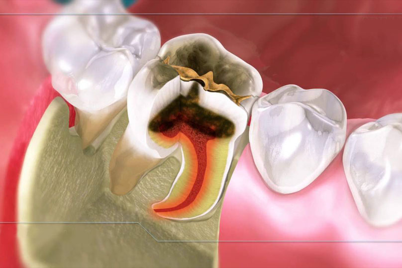 Viêm tủy khiến răng yếu dần, có nguy cơ gãy rụng