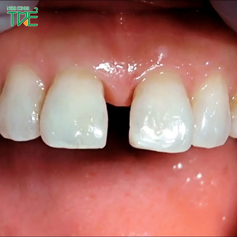 Làm thế nào để chữa trị răng cửa thưa tại nhà an toàn và hiệu quả?
