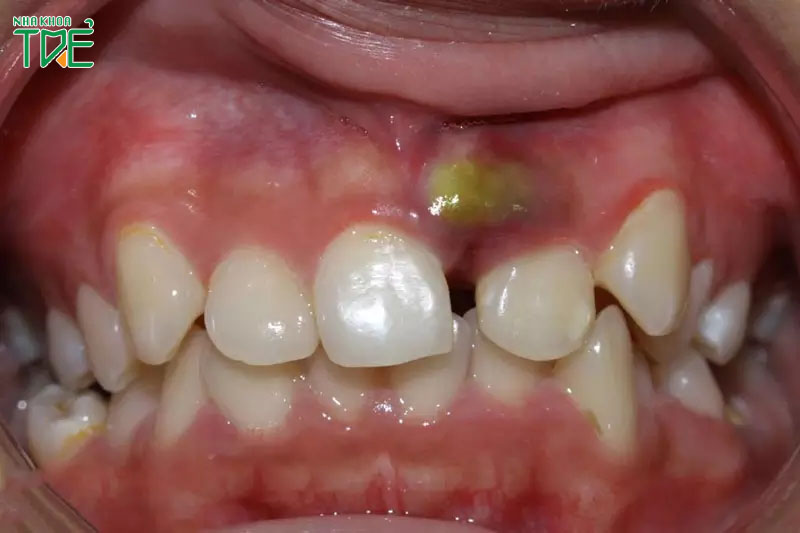 Chữa răng thưa tại nhà sai cách có thể gây viêm nhiễm vùng nướu