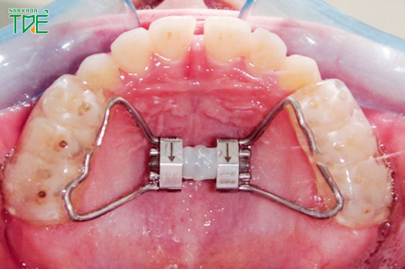 Dụng cụ nong hàm có tác dụng nới rộng vòm hàm