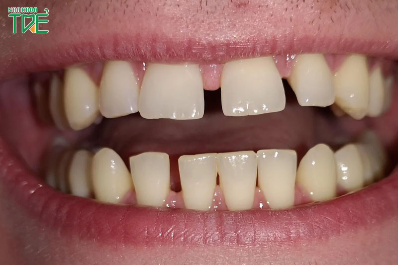 Giải pháp khắc phục răng cửa thưa hiệu quả nhất?