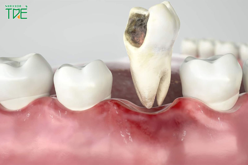 Nhổ răng hay mất răng số 5 cần trồng răng giả thay thế