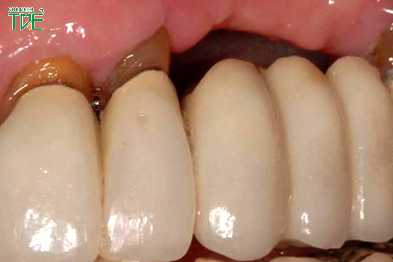 Cầu răng sứ không ngăn ngừa được tình trạng tiêu xương hàm