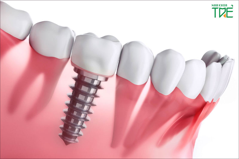 Trồng răng số 5 với Implant phục hình từ chân răng