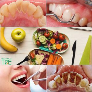 Lấy cao răng xong bao lâu thì ăn được? Cần lưu ý gì?