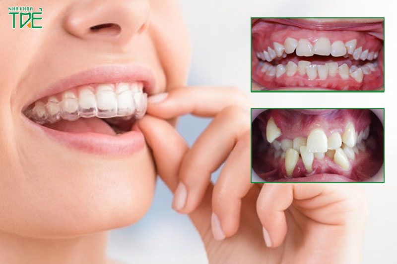 Niềng răng trong suốt Invisalign cho cả tình trạng răng đơn giản đến phức tạp