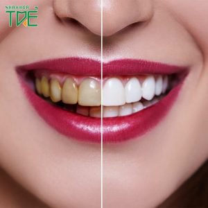 Tẩy trắng răng bằng phương pháp nào tốt nhất?