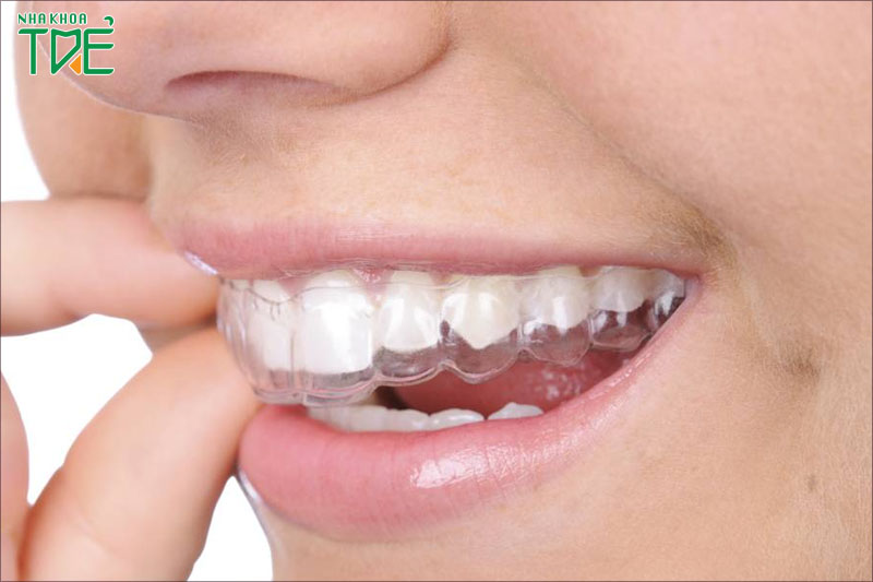 Tẩy trắng răng bằng máng cần nhiều thời gian để duy trì độ trắng răng