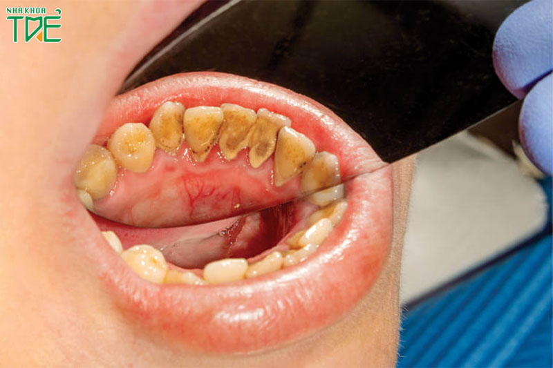 Cao răng là nguyên nhân chủ yếu gây viêm nướu, viêm lợi