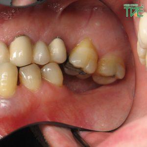 Nhổ răng số 6 có cần trồng lại không? Giải pháp nào hiệu quả nhất?