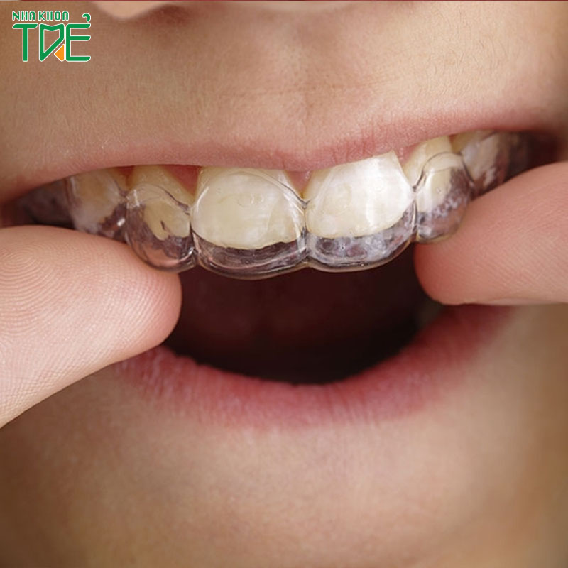 Niềng răng bằng máng nhựa là gì? Có hiệu quả không?